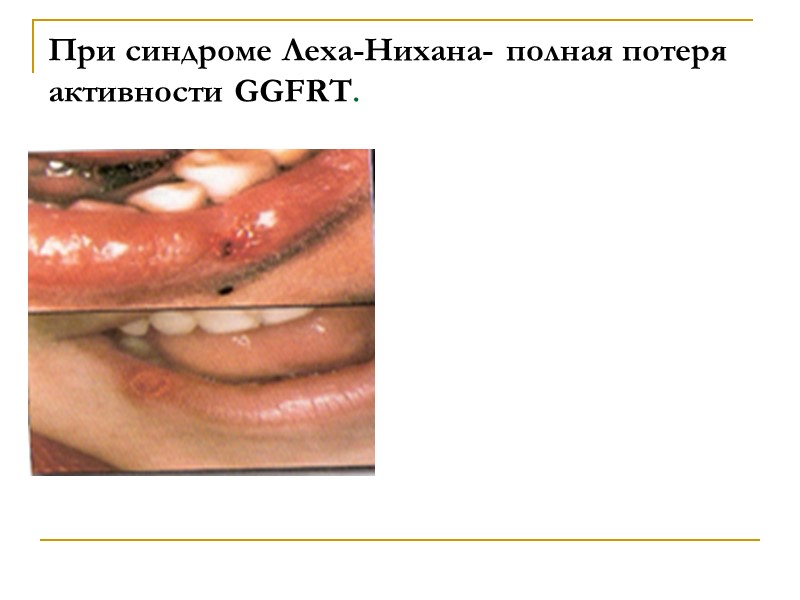 При синдроме Леха-Нихана- полная потеря активности GGFRT.